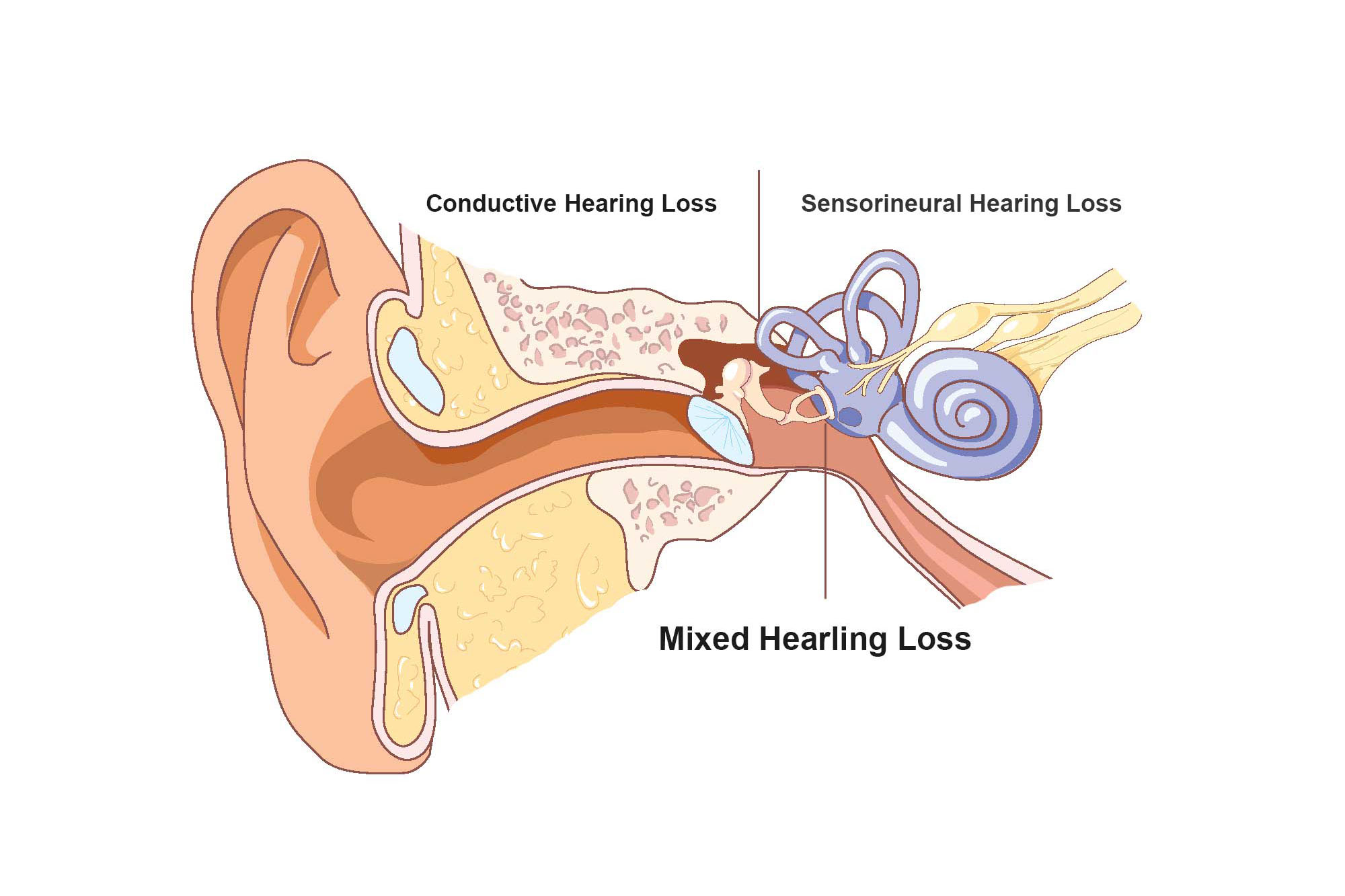 Types of Hearing Loss